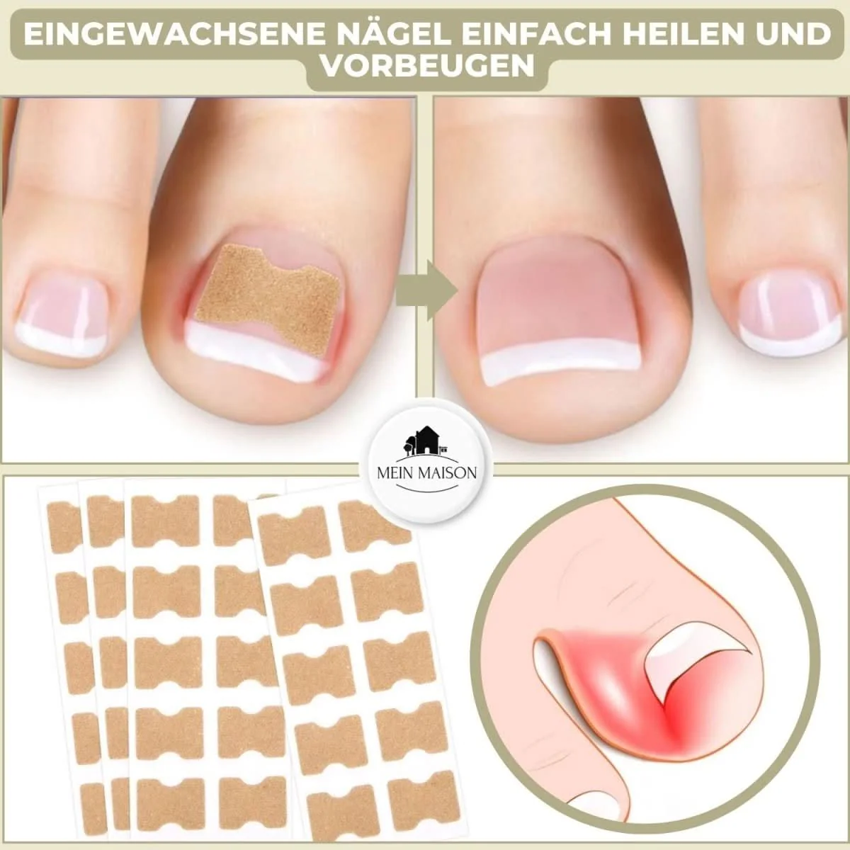 FixaNail - Gentle nail correction against ingrown nails & pain - Image 2