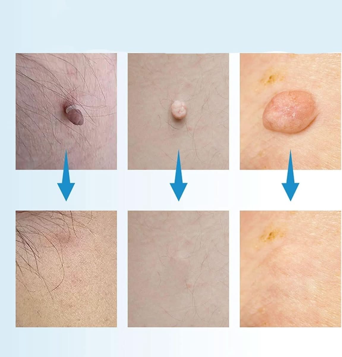 SpotOff Skin Tag Remover - Painless skin tag removal for neck, back & body - Image 2