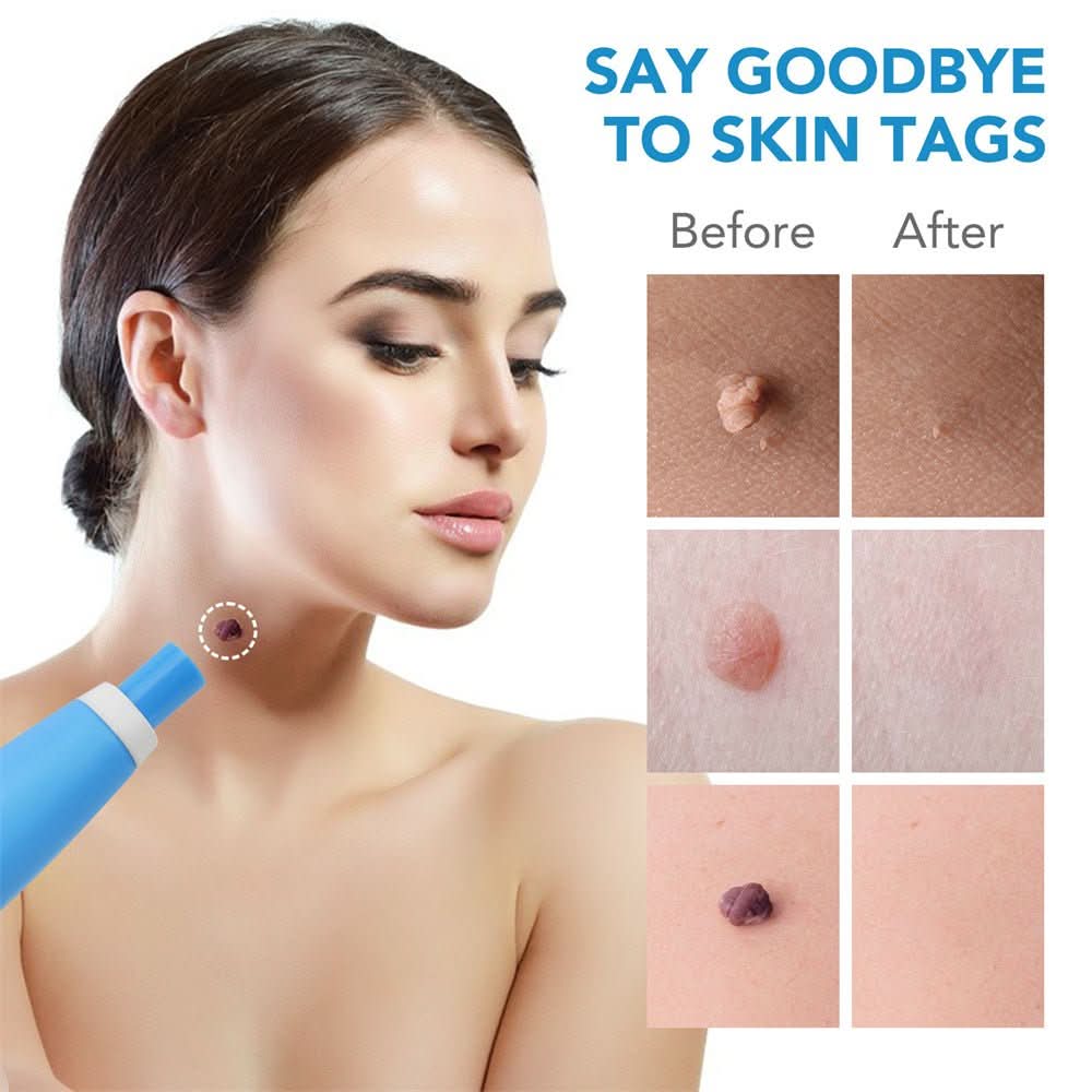 SpotOff Skin Tag Remover - Painless skin tag removal for neck, back & body - Image 6