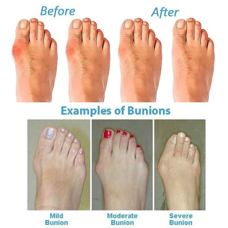 ORTHOSOLE SANDALS - Hallux Valgus sandals for pain-free walking - Image 8